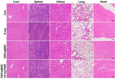 Gold nanoplatform for near-infrared light-activated radio-photothermal gas therapy in breast cancer